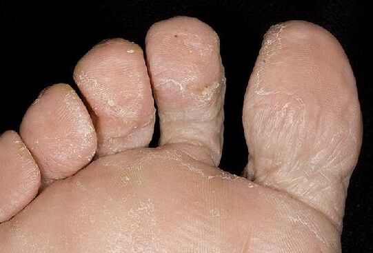 Manifestacións dunha infección fúngica nos pés
