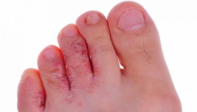 infección fúngica da pel dos dedos dos pés