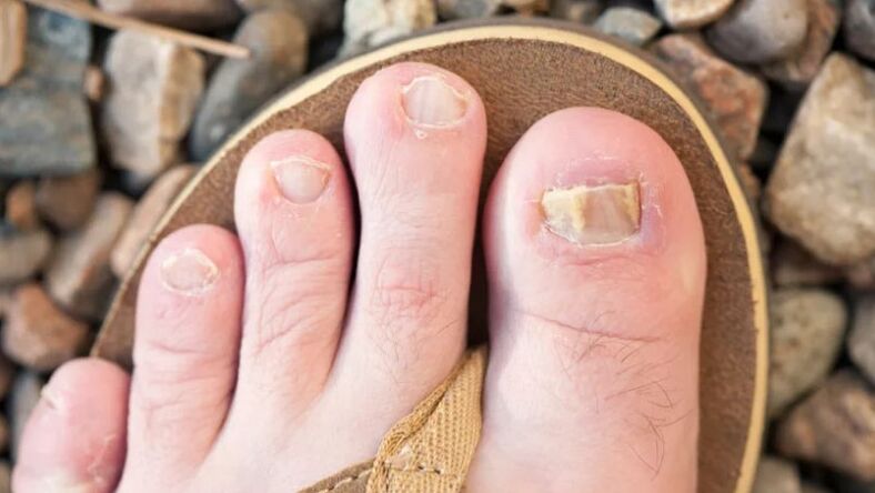 Micose de uñas
