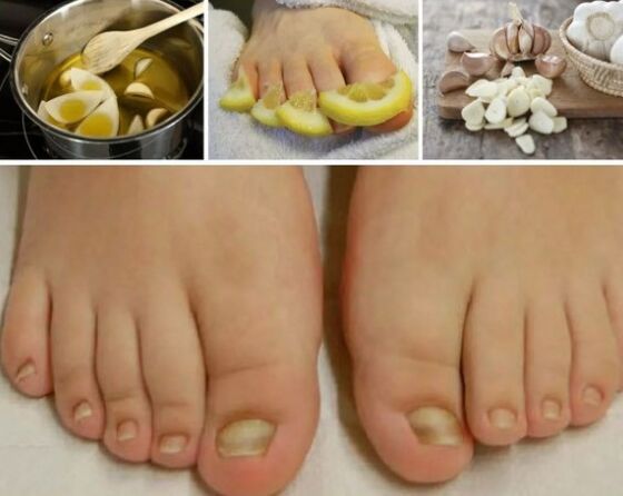 Remedios populares para o fungo das uñas