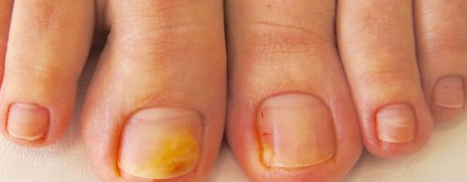 Fungo das uñas