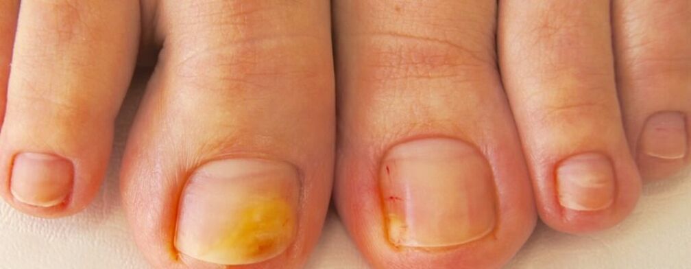 A fase inicial da onicomicose - amarelento das uñas dos pés