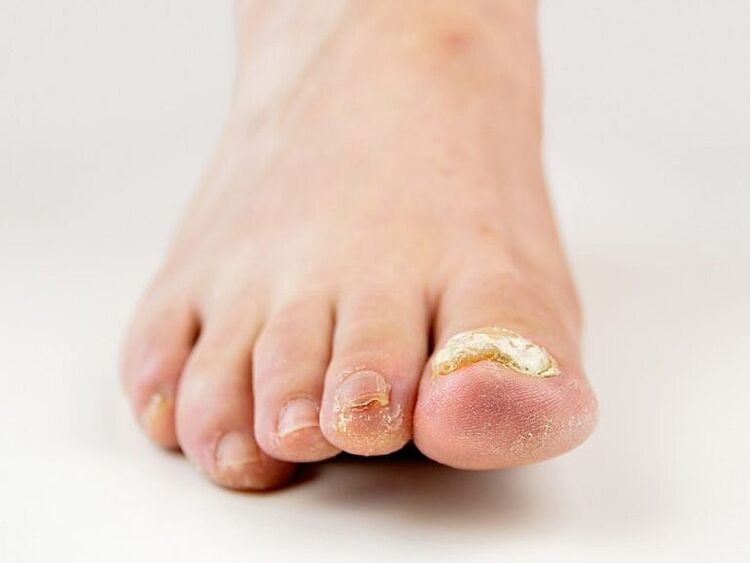 Engrosamento da placa ungueal no dedo gordo do pé cunha fungo
