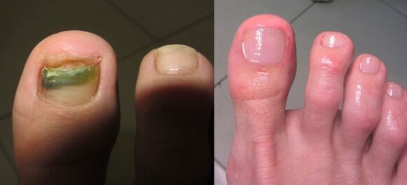 Tratamento do fungo das uñas
