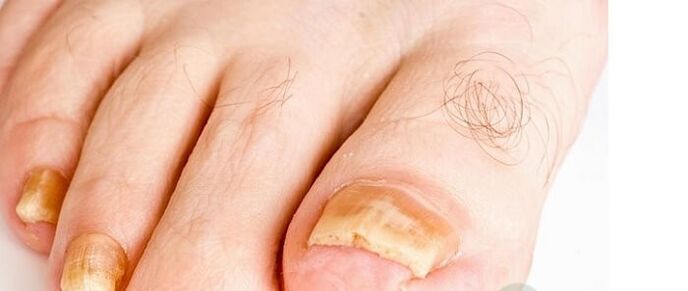 variedades do fungo das uñas do dedo