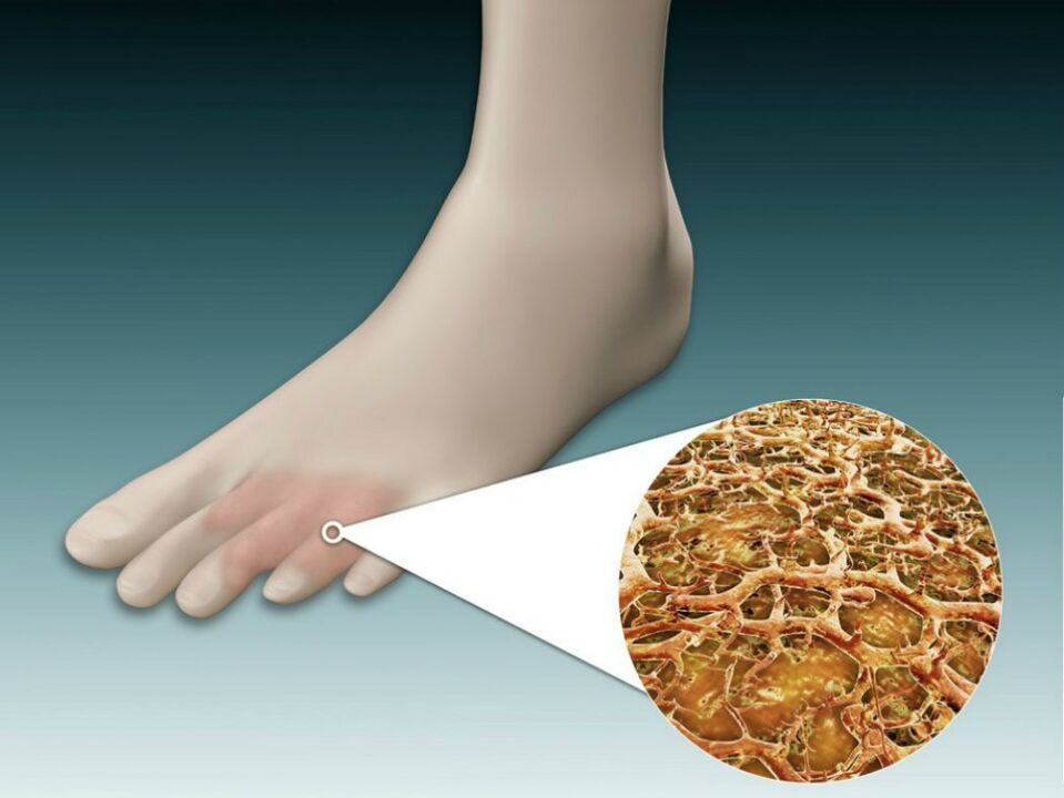 Vermelhidão da pel entre e preto dos dedos dos pés con fungo intertrixinoso