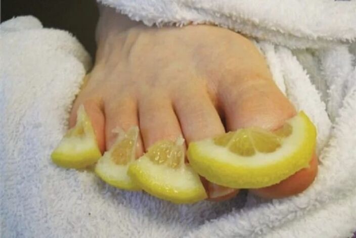 Compresas de gotas de limón - un remedio popular para o fungo das unhas dos pés